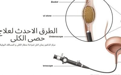 طرق علاج حصى الكلى؛ ما هي خيارات العلاج المتاحة؟ وميزة علاج الليزر