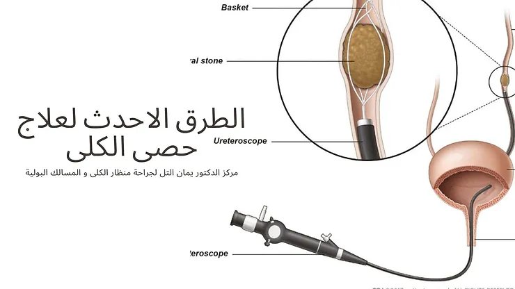 طرق علاج حصى الكلى؛ ما هي خيارات العلاج المتاحة؟ وميزة علاج الليزر