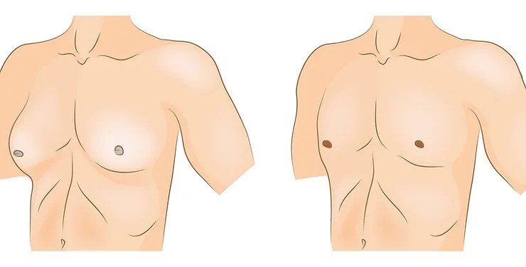 التثدي عند الرجال: ما سبب تضخم الثدي عند الرجل؟