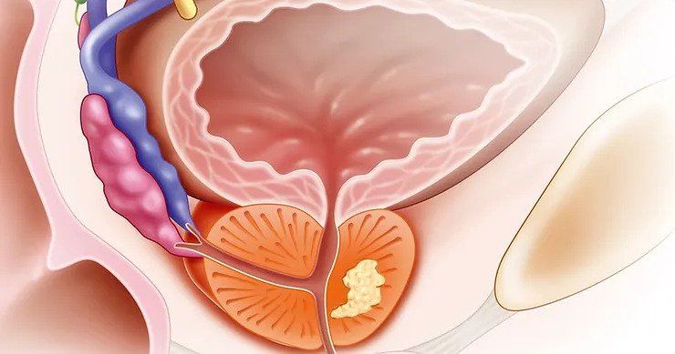 حصوات البروستاتا: أسبابها وتشخيصها وعلاجها